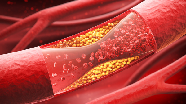 High Cholesterol: The First Steps in Lowering Your Cholesterol - Mosaic ...